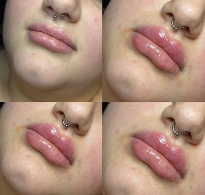 Revolax Deep HA Dermal Filler Lip Suntikan Ce Ditandai