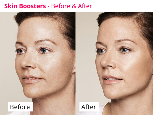PDRN Skinbooster Meso Serum Peremajaan Kulit Untuk Regenerasi Kolagen