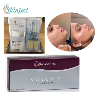 Juvederm Voluma Dermal Filler Hyaluronic Acid untuk Kontur Wajah Pipi Dagu