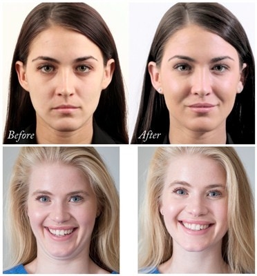 Juvederms Voluma Hyaluronic Acid Facial Filler Untuk Augmentasi Dagu dan Pipi