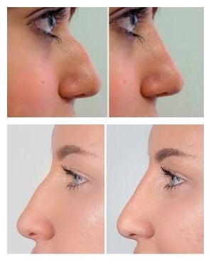 Juvederms Voluma Hyaluronic Acid Facial Filler Untuk Augmentasi Dagu dan Pipi