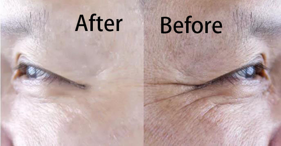 Asam Hyaluronic Filler Regenerasi Kolagen Pemutih Dan Anti Penuaan Injeksi