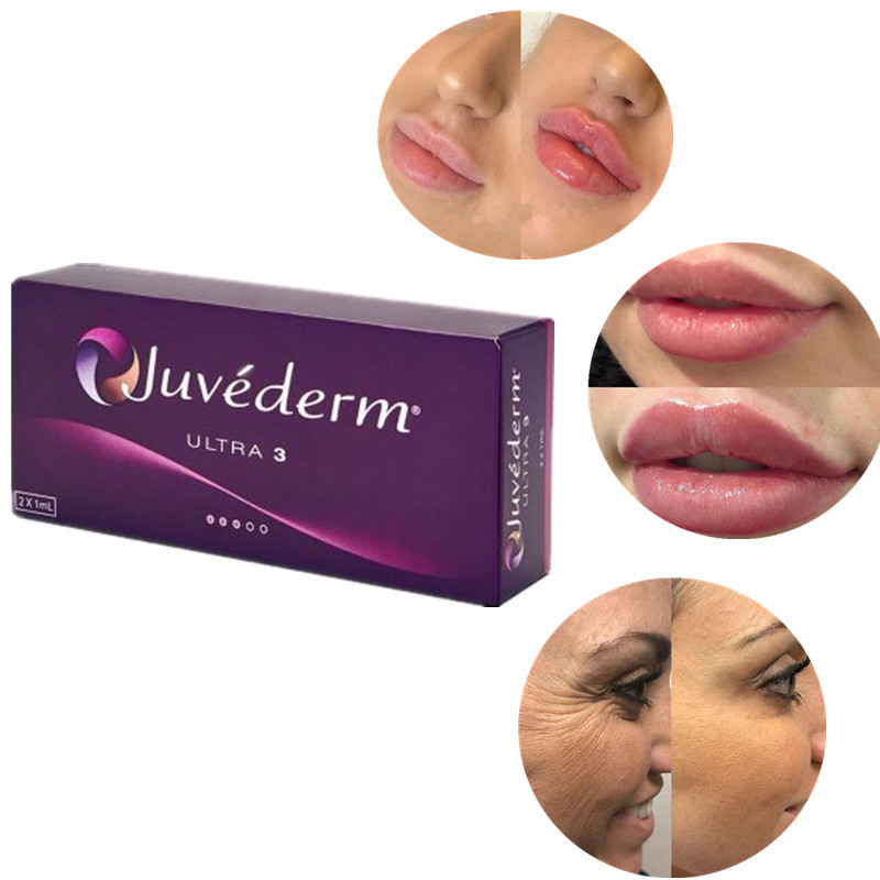 Pengisi Asam Hyaluronic Dermal Silang Aman Untuk Semua Jenis Kulit