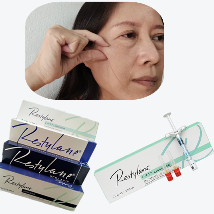 Kosmetik Cross Linked Dermal Filler HA Injeksi Untuk Sudut Mulut
