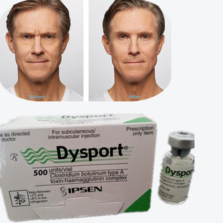 Botulinum Toxin Dysport 100IU Botulinum Toxin Type A untuk Penghapusan Kerutan