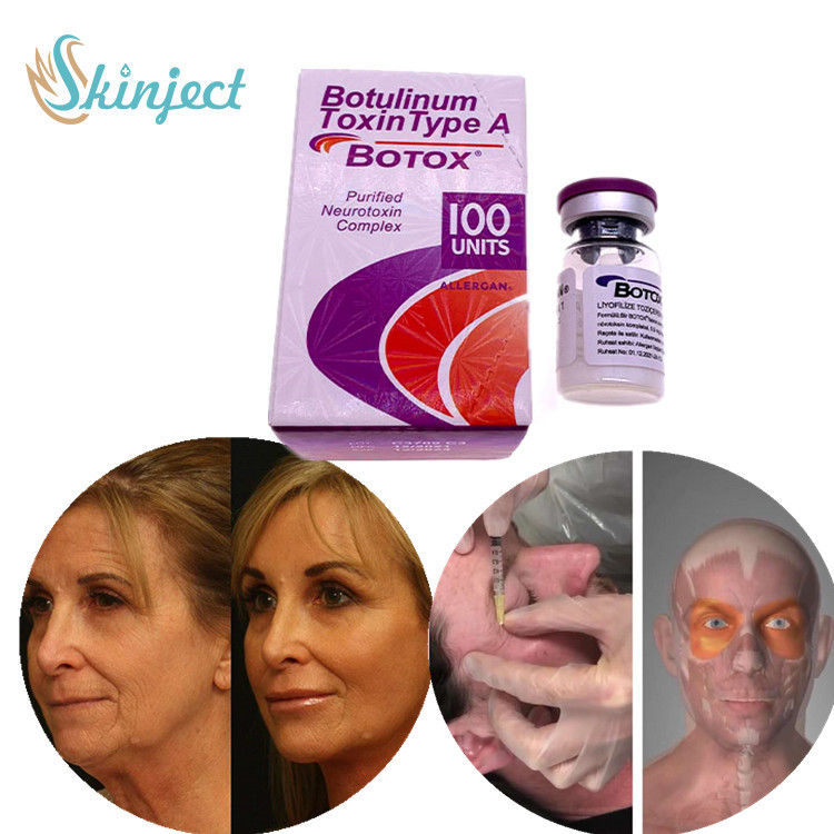 Facial Botulinum Toxin Tipe A Injeksi Penghapusan Kerut